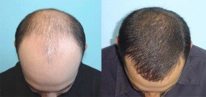 hair transplant